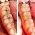 Can a hygienist see cavities?