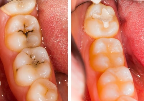 Can a hygienist see cavities?